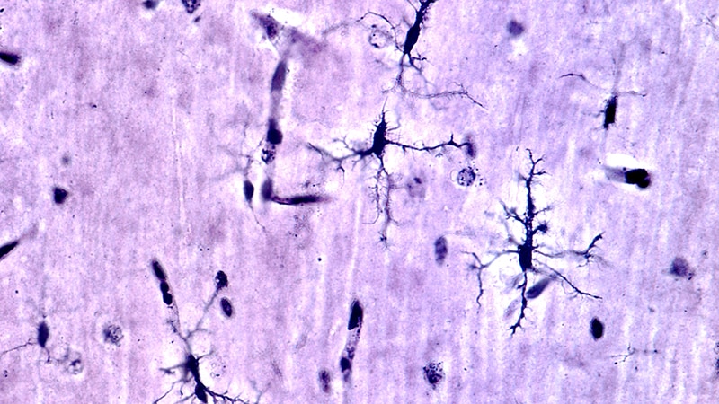 Ces cellules qui déclencheraient la maladie d'Alzheimer... Que dit la recherche ?