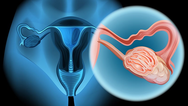 Cancer de l'ovaire avancé : des résultats de survie globale ...