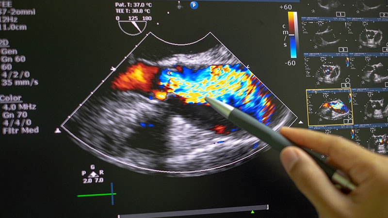 sténose aortique radiographie