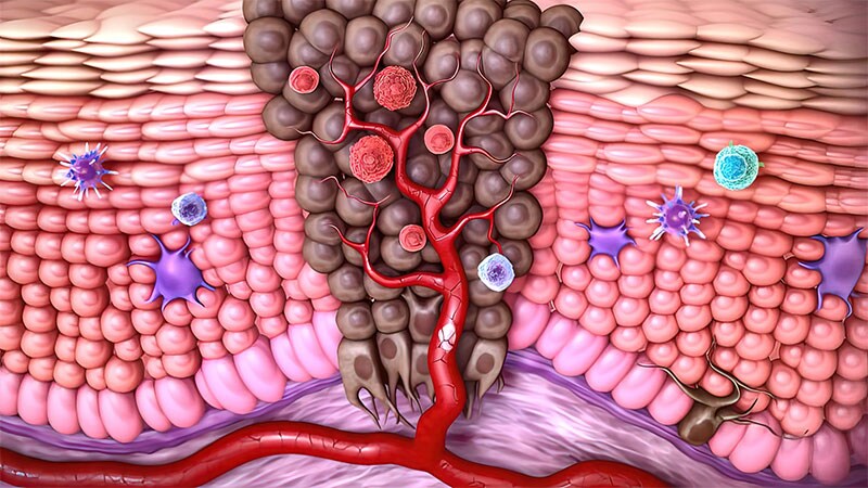 Carcinome Pidermo De Avanc Un Traitement Efficace Mais Non Rembours