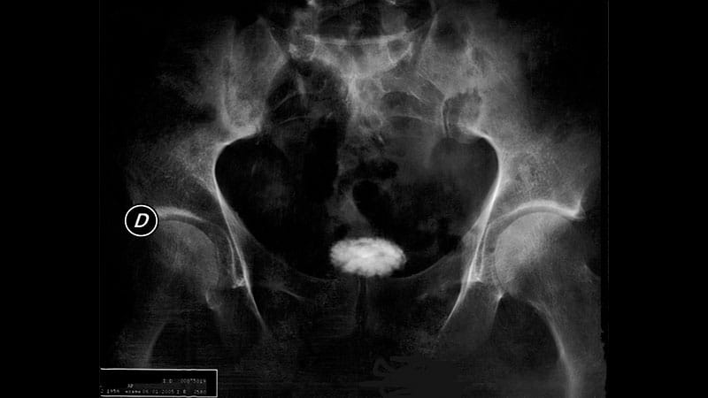 Toxine botulique et vessie hyperactive: émergence d’un nouveau schéma d ...