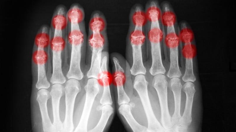 Un médicament contre l'ostéoporose pourrait limiter l’arthrose érosive ...