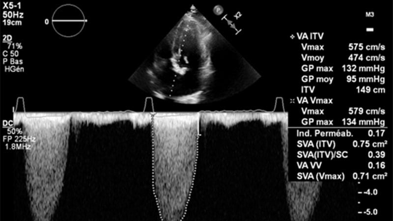 clinical-case-aortic-stenosis-and-anemia-archyworldys