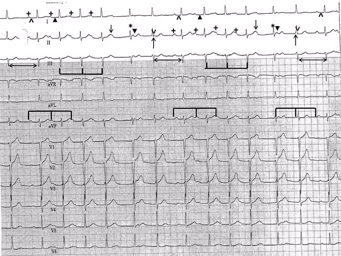 ECG : exacerbation de BPCO et rythme cardiaque irrégulier - Page 2