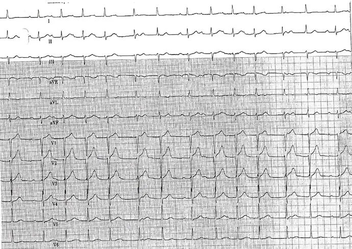 ECG : exacerbation de BPCO et rythme cardiaque irrégulier