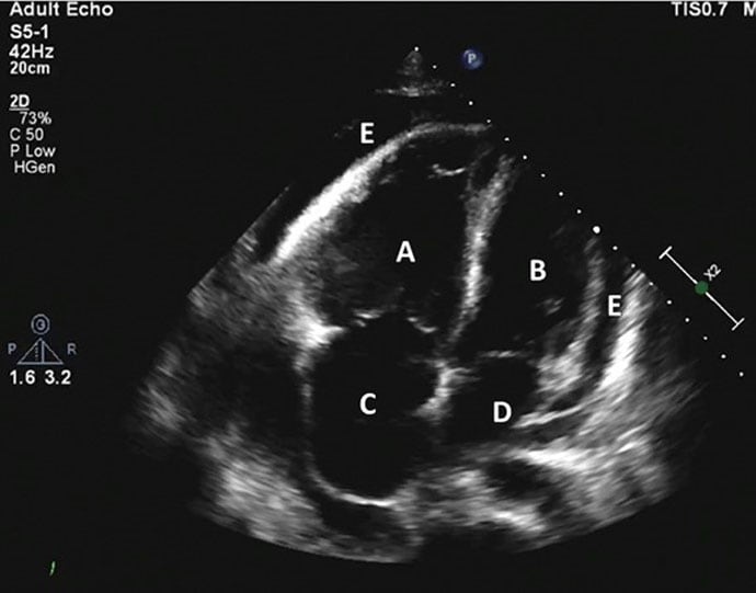 Cas clinique détresse respiratoire après ablation de flutter par radiofréquence Page 2