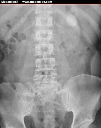 Milk of Calcium in a Pyelocaliceal Diverticulum