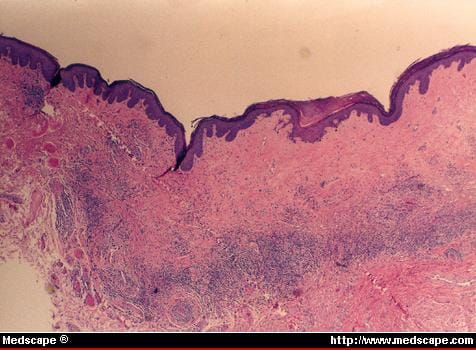 Lesions on the Penis