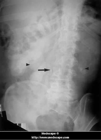 a-tortuous-ureter-and-urolithiasis