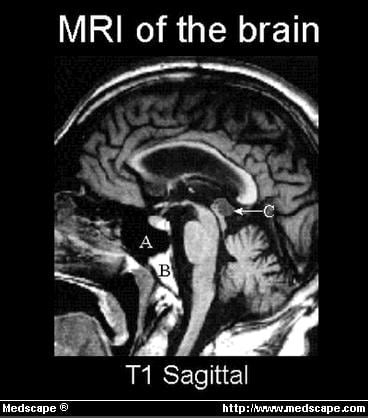 A 36-Year-Old Man With Progressive Dementia, Gait Ataxia, and Visual...