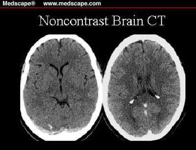 A 28-Year-Old Woman With Severe Headaches