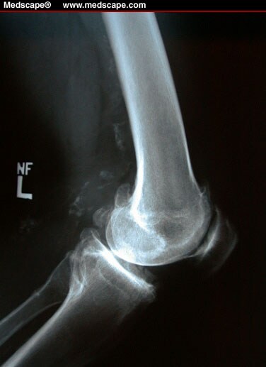 Knee Soft Tissue Injury (ACL, LCL, MCL, PCL) Management in the ED