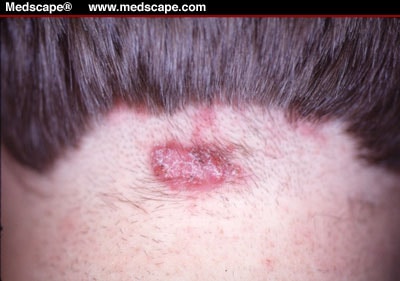 Dark-Red Nodule on the Neck