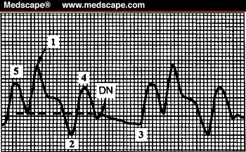 Interpreting the Arterial Pressure Waveform - Page 2