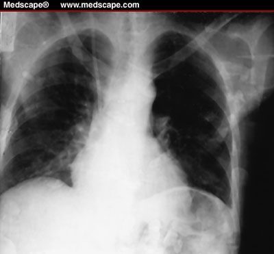 Tuberculous Pericarditis: A Report of Three Cases