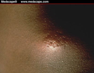 Cutaneous Anthrax