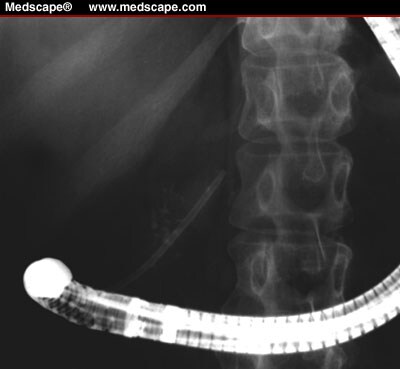 David Carr-Locke Endoscopy Clinic - Pancreatic Duct Disruption