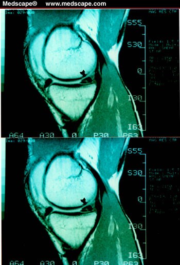 Meniscal Lesions: Diagnosis And Treatment - Page 5