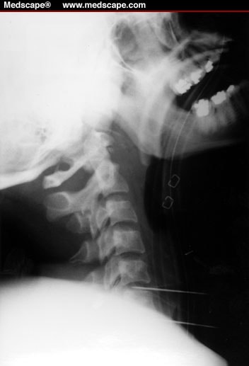 Anteromedial Approach for Cervical Disc Surgery - Page 3