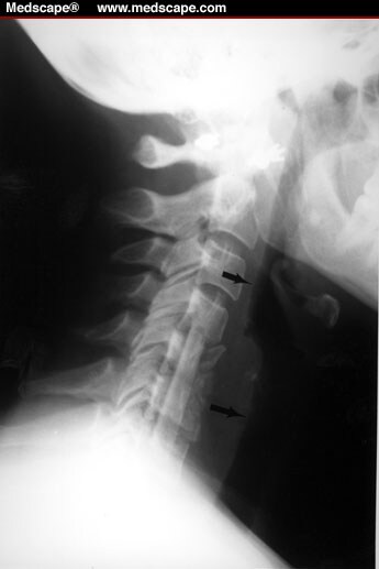 Anteromedial Approach for Cervical Disc Surgery - Page 3