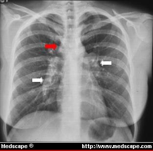 Case Study: Pulmonary Sarcoidosis