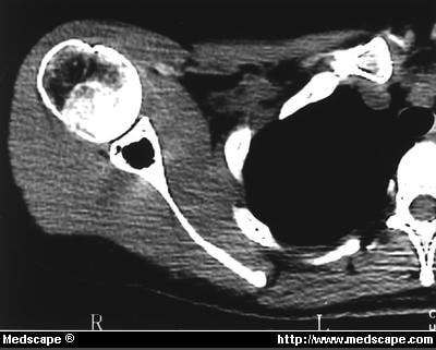 Intraosseous Ganglia of Glenoid - Page 2