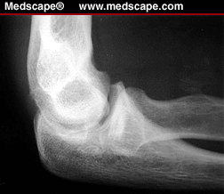 Elbow Arthroscopy - Page 2