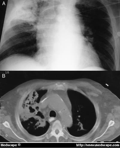 Disseminated Pseudomonas aeruginosa