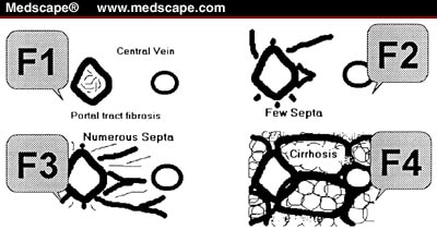 Fibrosis In Patients With Hepatitis C: Detection And Significance - Page 2