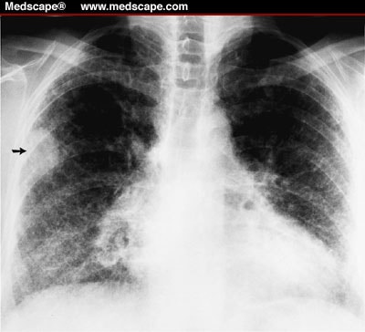 Usual Interstitial Pneumonia