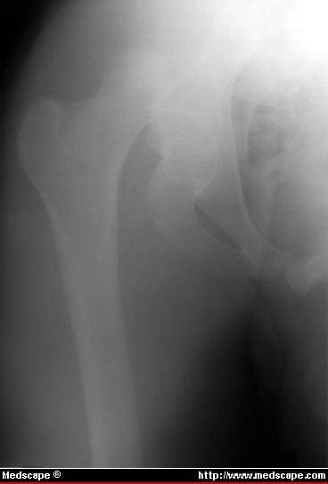 Hip Dislocation