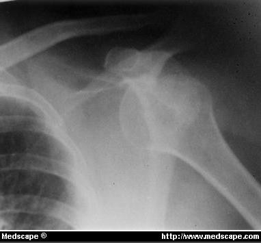 Radiograph Showing Recurrent Anterior Shoulder Dislocation