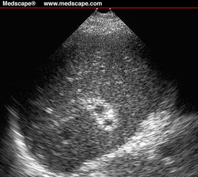 Acute Hepatitis in a 44-Year-Old Woman