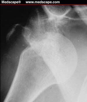 treatment torus fracture humerus treatment torus fracture humerus