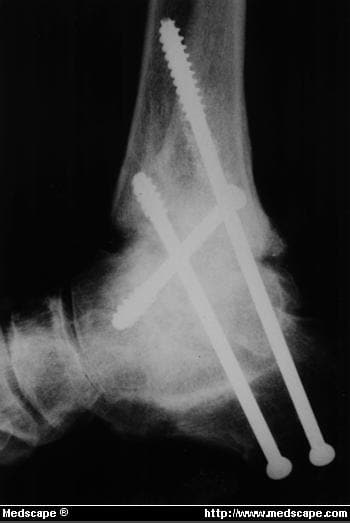 Tibiotalar Salvage Procedures for Failed Ankle Arthrodesis - Page 4