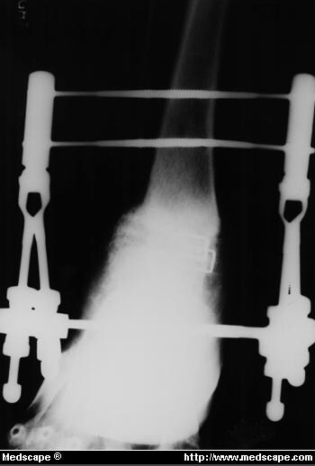 Tibiotalar Salvage Procedures For Failed Ankle Arthrodesis - Page 4