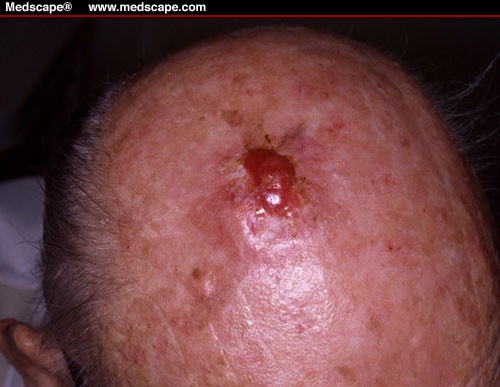 Persistent, Friable Nodule of the Scalp