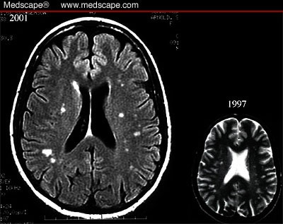 Case 14: Headache and Unilateral Visual Changes