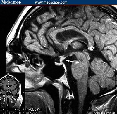 Man With Polyuria and Polydipsia