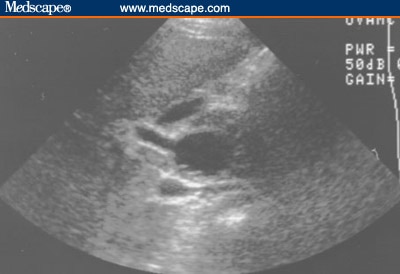Young Girl With Right Upper Quadrant Abdominal Pain