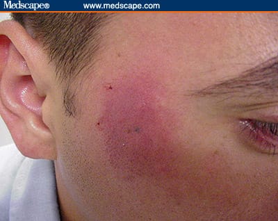 Temple Rash A Lingering Facial Rash