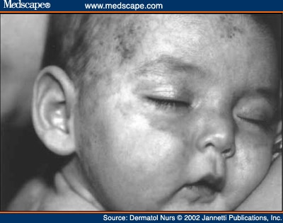 Neonatal Lupus Erythematosus - Page 4