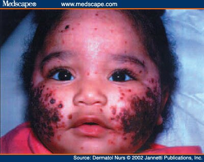 Eczema Herpeticum: A Dermatologic Emergency - Page 2