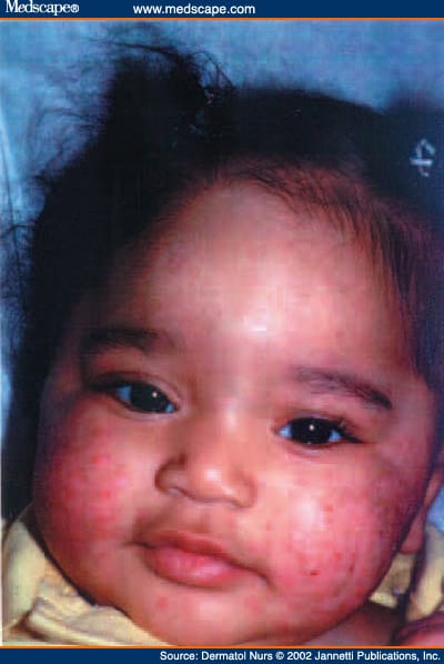 Eczema Herpeticum A Dermatologic Emergency