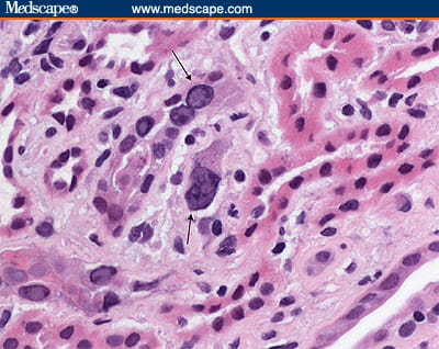 Polyomavirus Allograft Nephropathy - Page 2