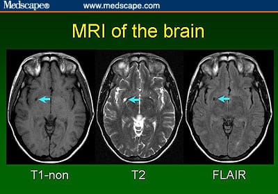Epilepsy Brain Mri Distinguishing Temporal Lobe Epilepsy With Mesial