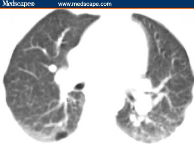 PET Case Cavalcade, Case IX: Postmammographic Evaluation