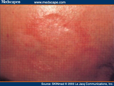 Circinate Sarcoidosis Of The Face circinate-sarcoidosis-of-the-face