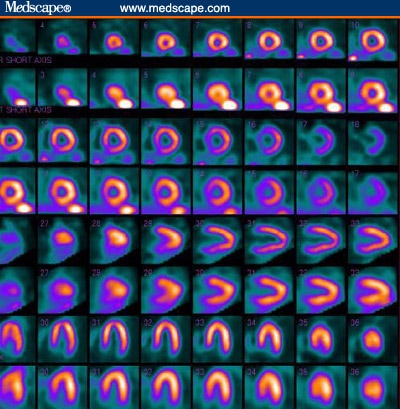 Role of Myocardial Perfusion Imaging in Managing CAD - Page 5