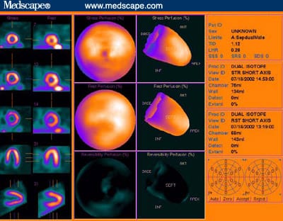 Role of Myocardial Perfusion Imaging in Managing CAD - Page 5